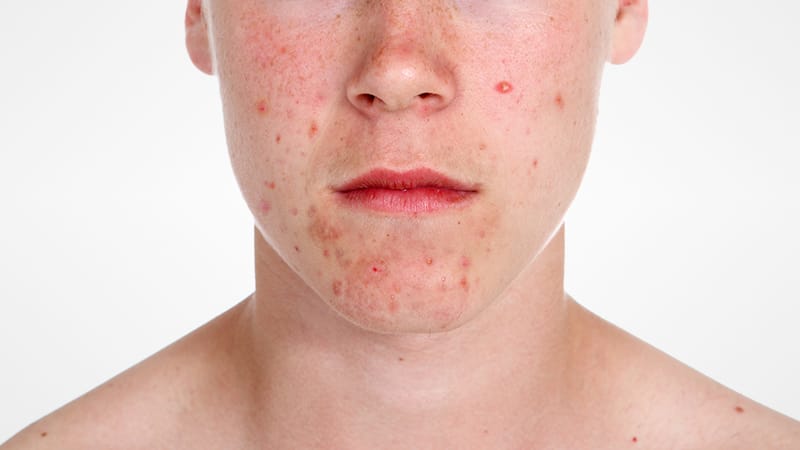 accutane france