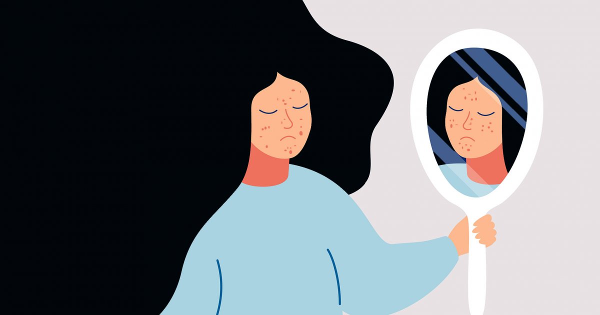 Pilule contre roaccutane