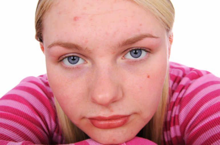 Pilule pour roaccutane