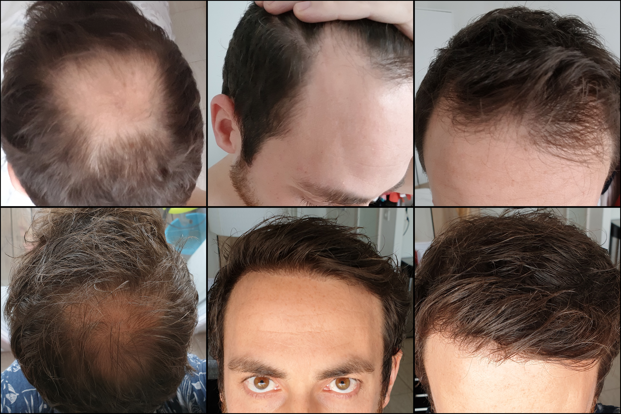Propecia Finasteride Prix