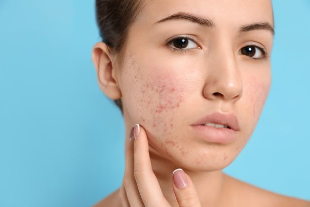 Accutane 30mg Online