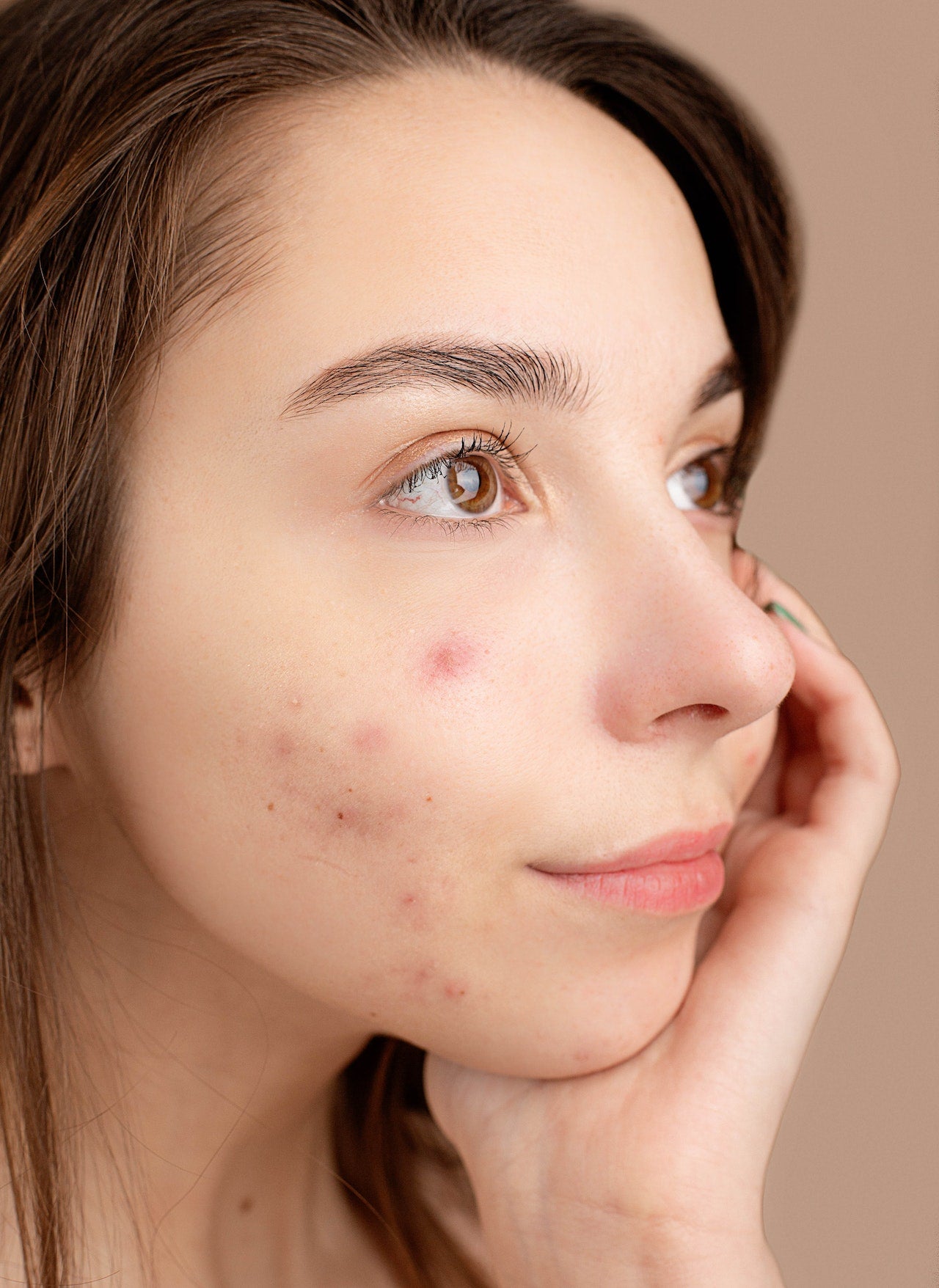 Commander roaccutane