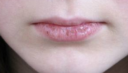 commander roaccutane en ligne