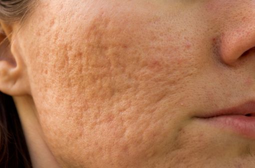 Comment se procurer roaccutane sans ordonnance