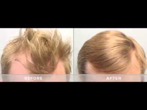 finasteride achat internet
