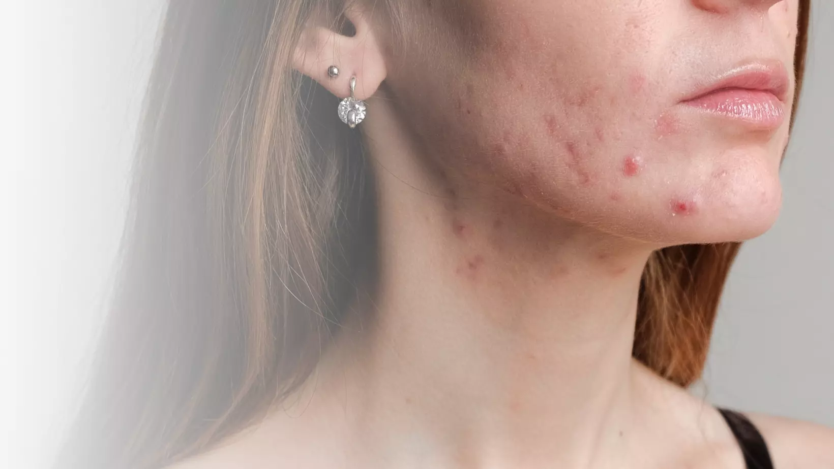 acheter roaccutane gel