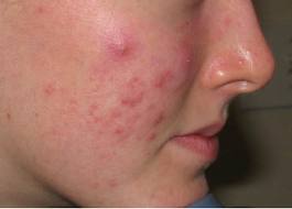 Roaccutane avec pilule