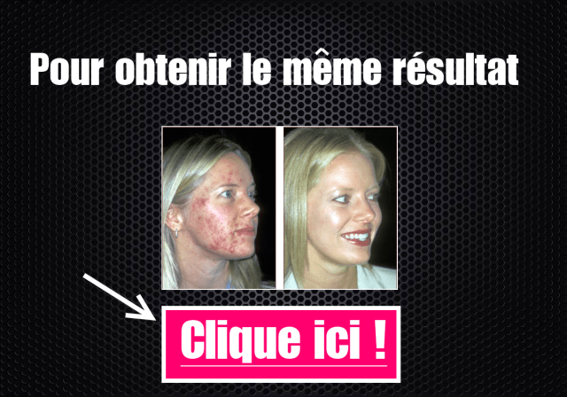 Acheter roaccutane gel