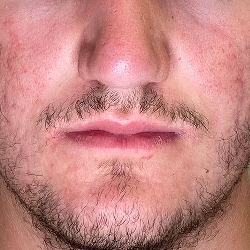 Pilule De Roaccutane