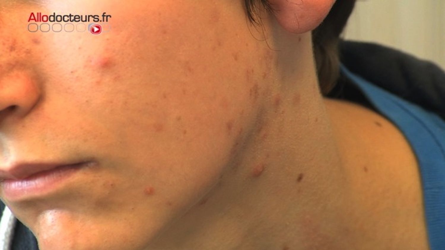 Roaccutane pilule obligatoire