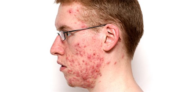 Isotretinoin gel online