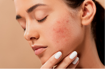 Prix pour accutane