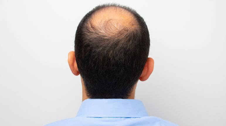 Finasteride Bailleul Prix