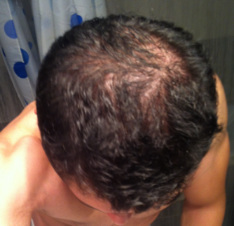 finasteride moins cher