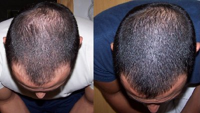 Finasteride pilules