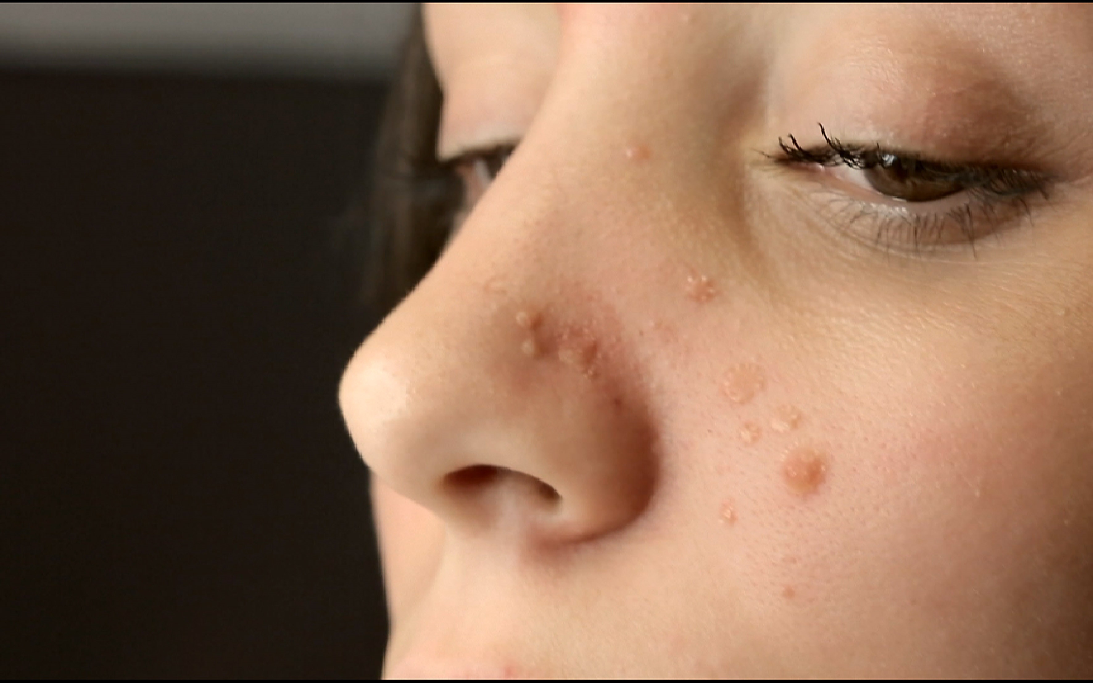 isotretinoin pilule