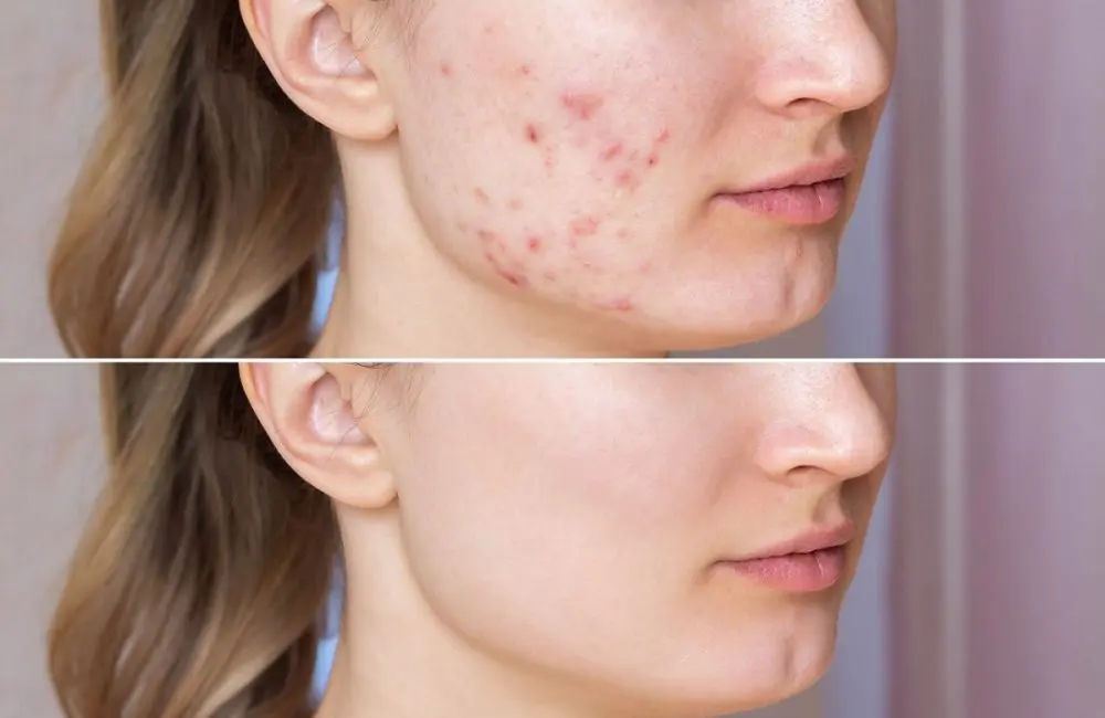 Ordre Roaccutane