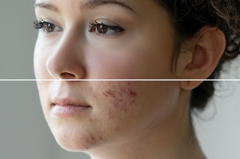 Peut On Avoir Accutane Sans Ordonnance