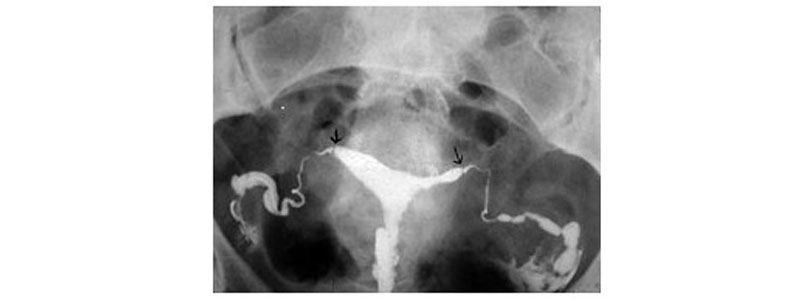 Peut on avoir clomid sans ordonnance