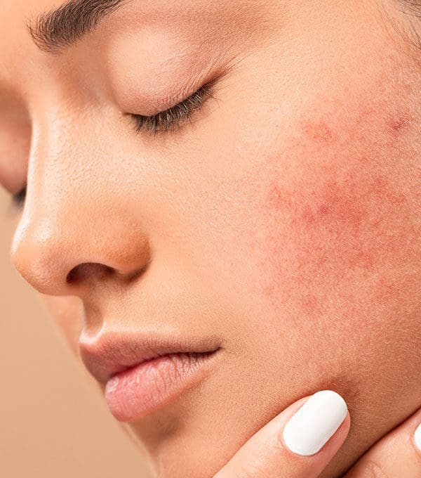 Prix du accutane prix du accutane
