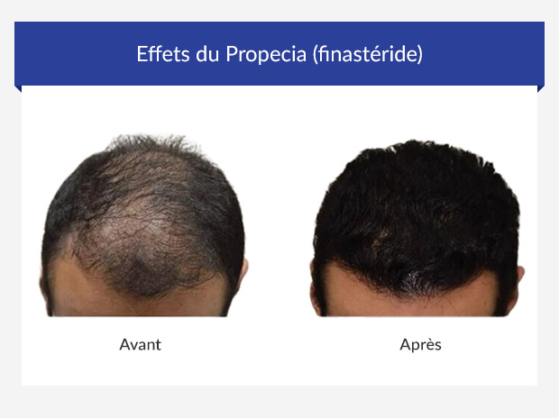 propecia vente en ligne