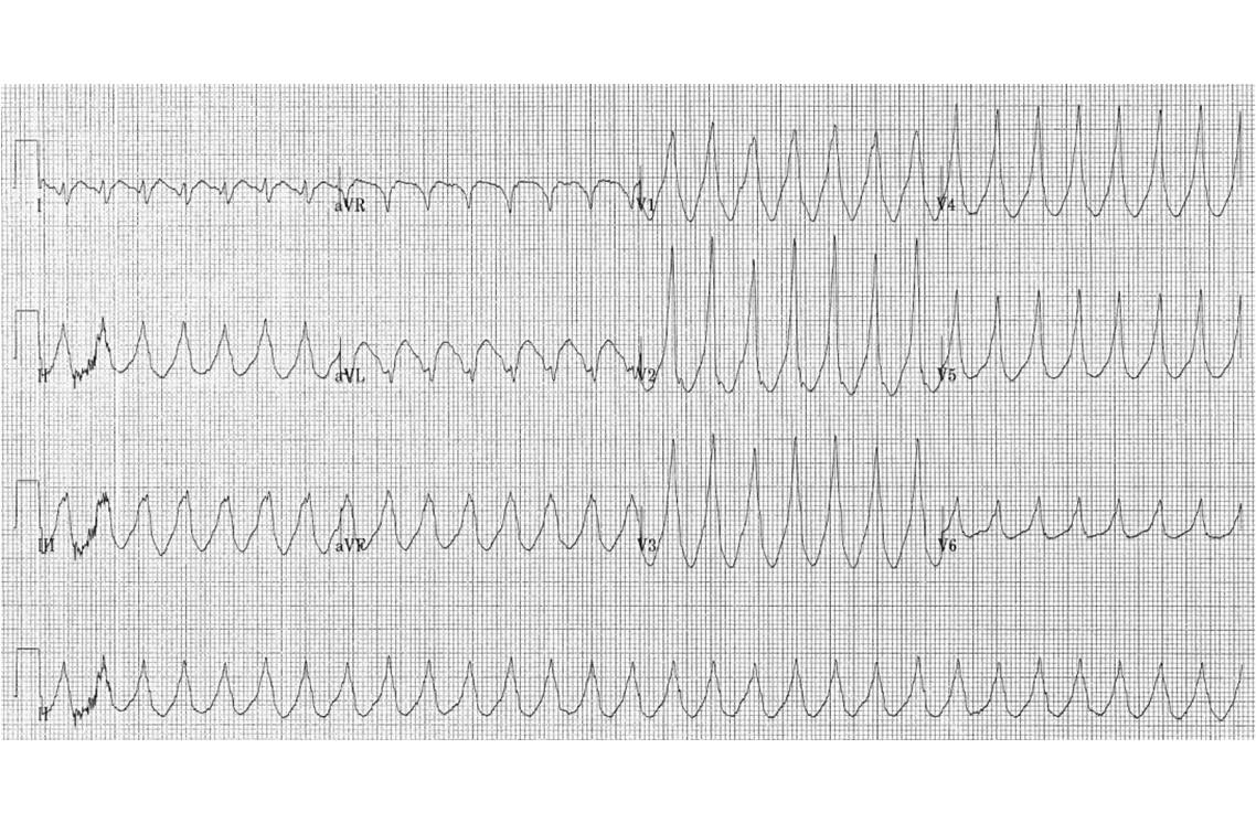 propranolol 20 mg