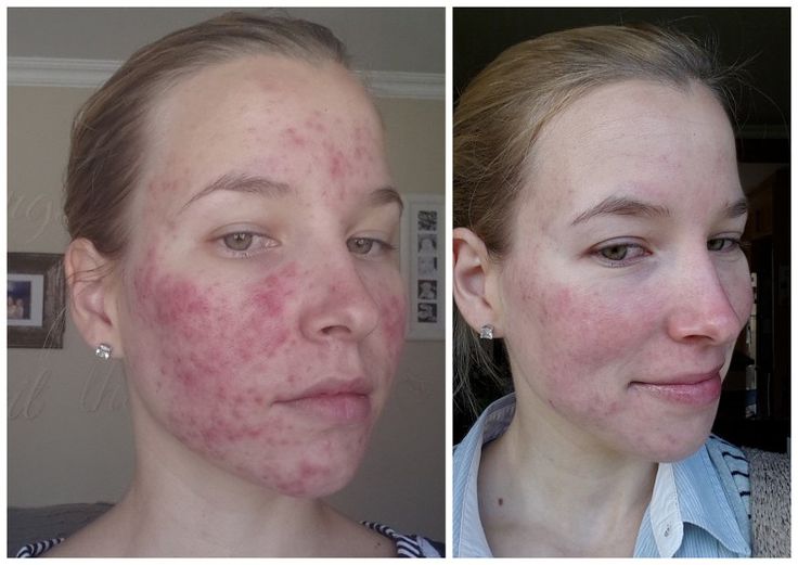 Roaccutane 40 mg prix