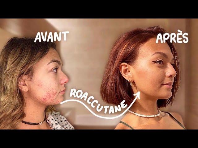 Roaccutane avec pilule