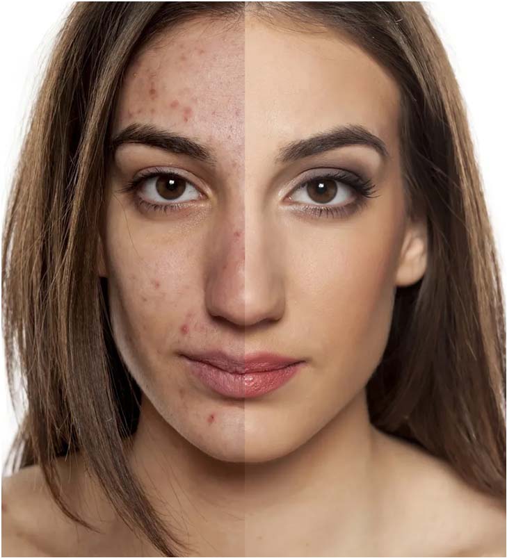 Roaccutane bnf online