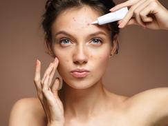 Roaccutane Gel Achat En Ligne