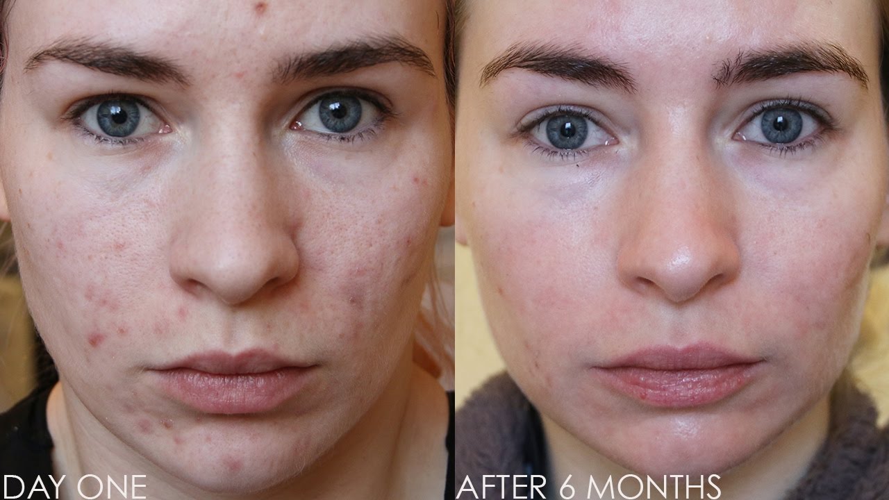 Roaccutane moins cher
