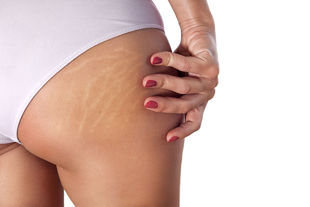 Roaccutane prix belgique