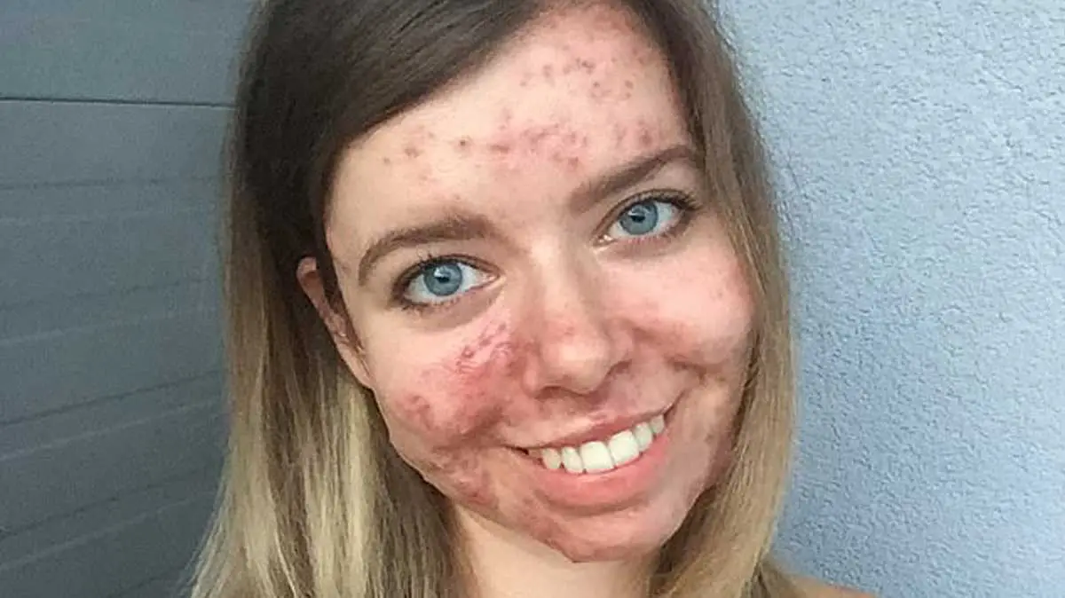 Roaccutane sans contraception